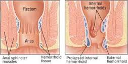 Illustration for article titled obat ambeien alami